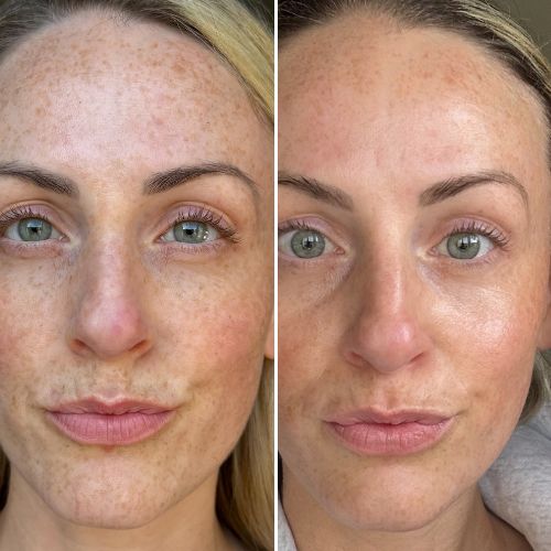 Maschera al collagene per una pelle luminosa